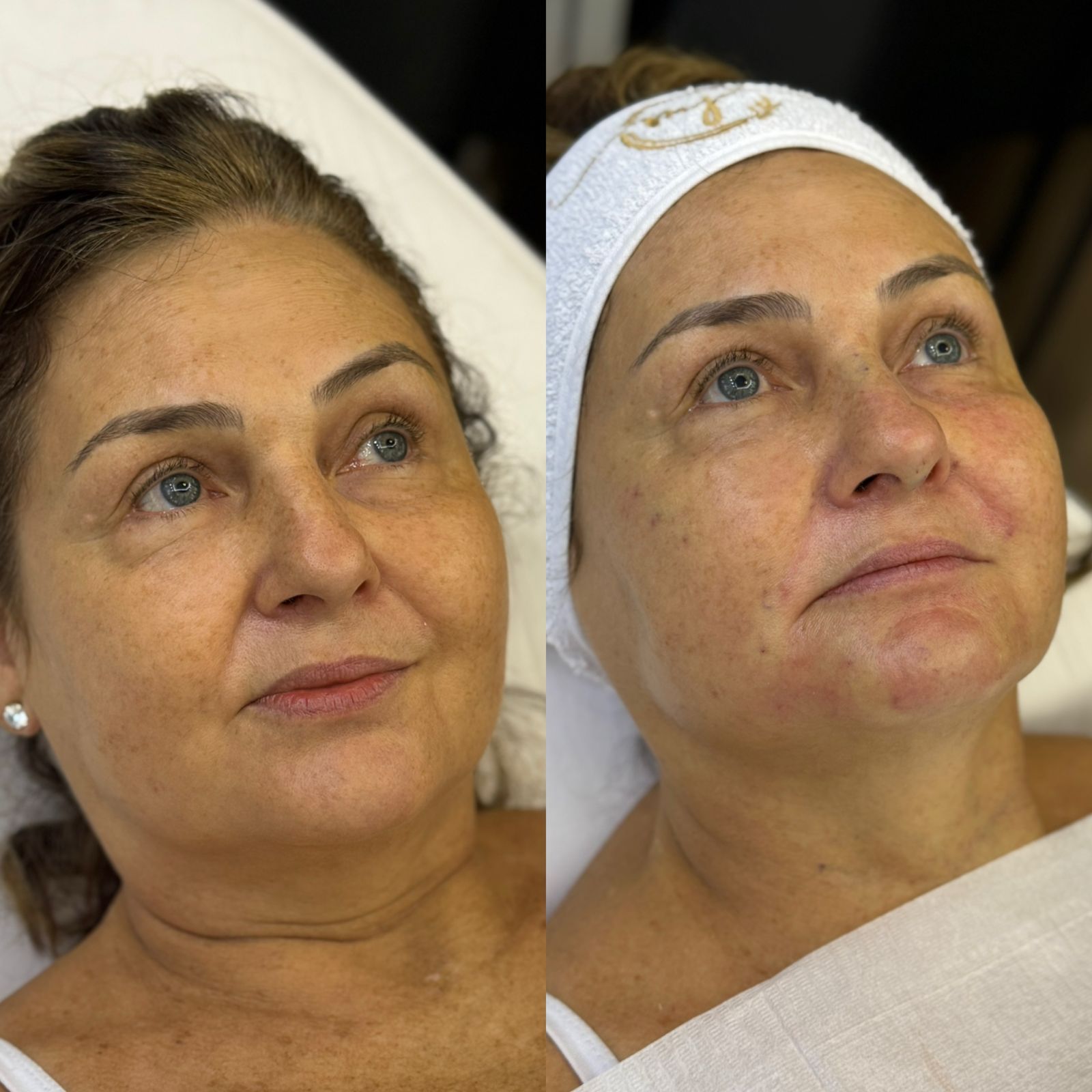 Resultado Antes e Depois